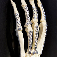 Magnesiumlegierung-Knochenimplantat