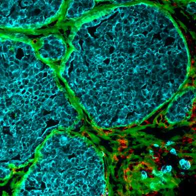 Tumor tissue, stasined in blue