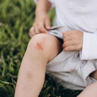 Child with an abrasion on his knee. It is sitting in the grass.